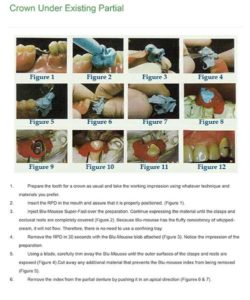 Steps for the creation of a partial index Crown Under Existing Partial at Global Dental Solutions