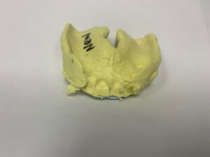 The green color poor wash impressions from global dental solution The green color poor wash impressions from global dental solution