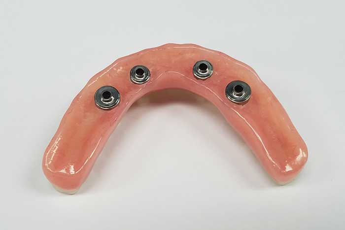 The hybrid denture in screw type at Atlanta, GA The hybrid denture in screw type at Atlanta, GA