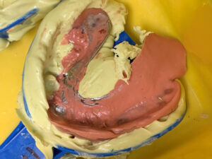 the cast partial covers the metal major connector from Global dental solution the cast partial covers the metal major connector from Global dental solution