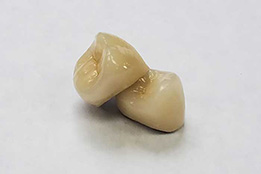 Porcelain Fused To Metal Porcelain Fused To Metal Crown by Global Dental Solutions