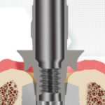 An Infographic image highlighting when the RB/WB healing abutment was used