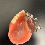 An obturator for the upper right quadrant and palate.