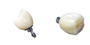 Ceramic Screw Teeth Ceramic Screw-Retained Dentures from Global Dental Solutions