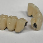 Broken teeth for Tube Attachments from Global Dental Solutions at Atlanta, GA Broken teeth for Tube Attachments from Global Dental Solutions at Atlanta, GA