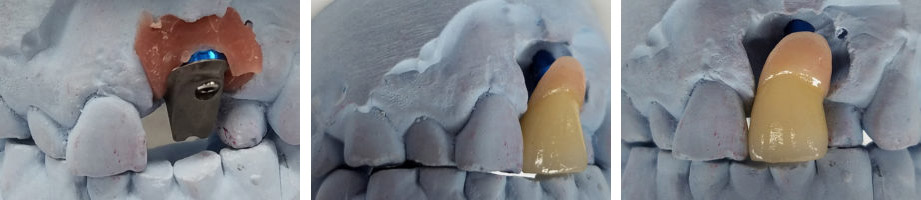 The Porcelain Fused to Metal by Global Dental Solutions at Atlanta, GA The Porcelain Fused to Metal by Global Dental Solutions at Atlanta, GA