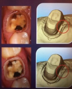The model of gingival tissue retraction from global dental solution at Atlanta, GA Dental procedure demonstrating gingival tissue retraction