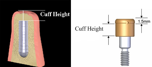 Cuff for screw from Global Dental Solutions at Atlanta, GA Cuff for screw from Global Dental Solutions at Atlanta, GA